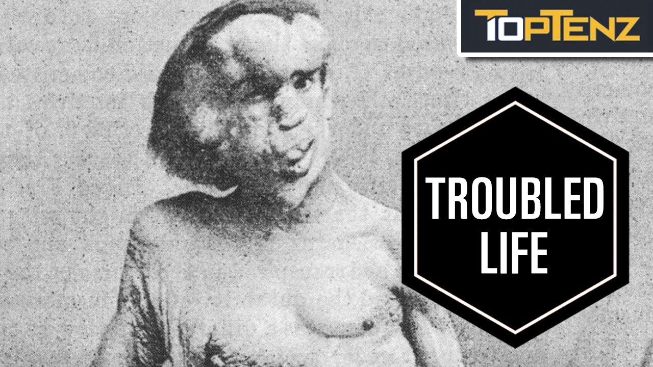 10 Sad Facts About “The Elephant Man” Joseph Merrick