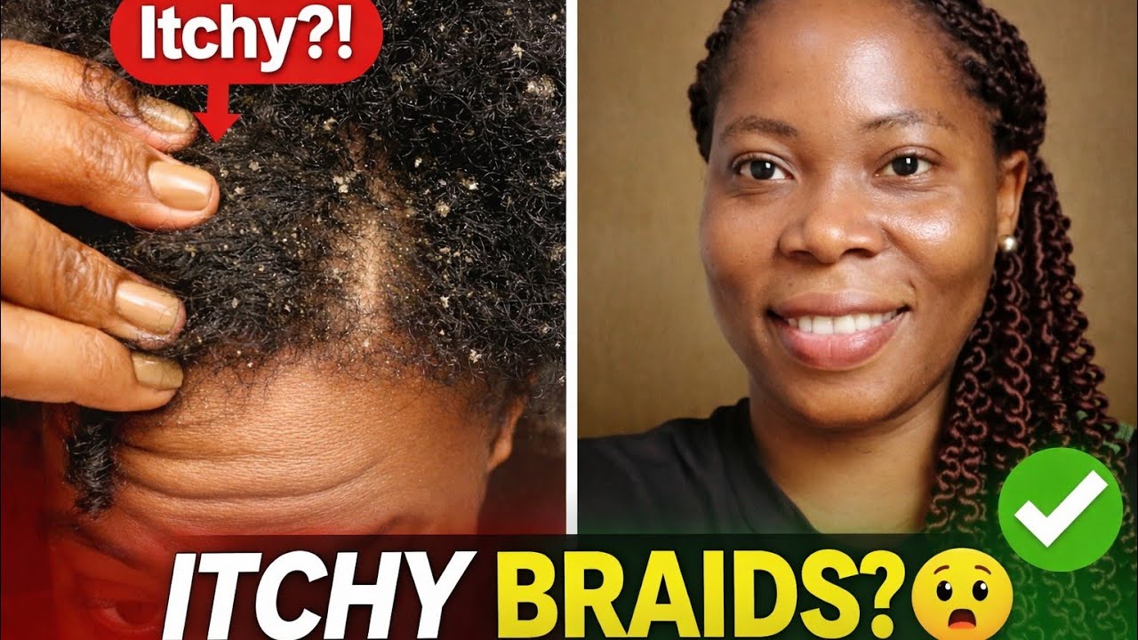 No More Itchy Braids! My Simple Scalp Care Routine for Dry, Flaky Scalp
