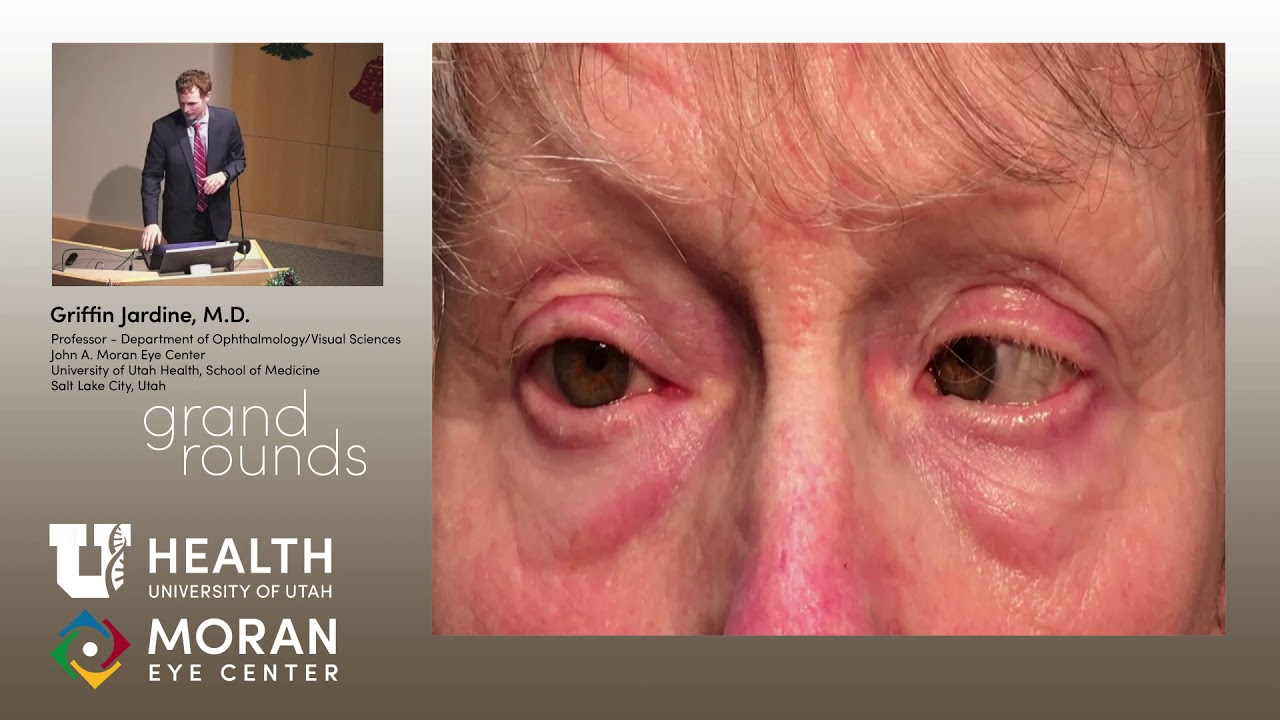 Sudden Onset Strabismus: To Image Or Not To Image?