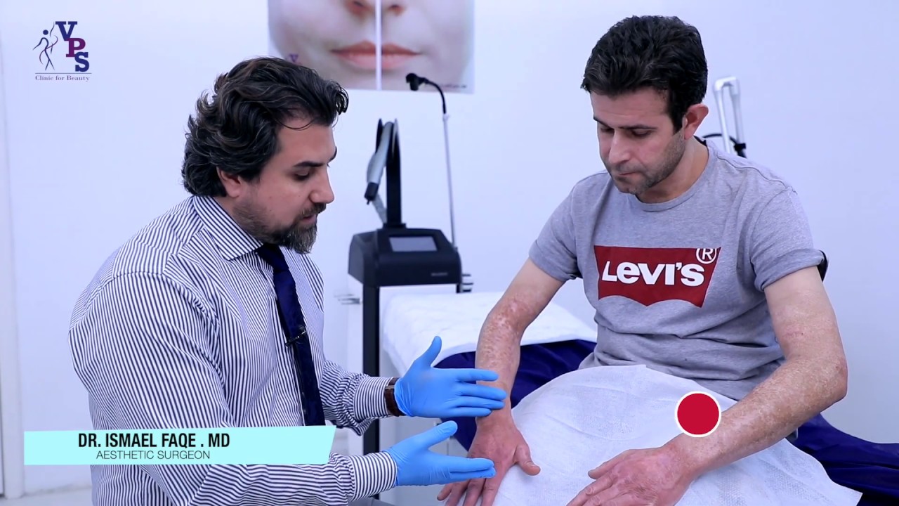Post burn Treatment  at VPS Clinics -  چارەسەری ئاسەواری دوای سوتان لە سەنتەری جوانکاری VPS
