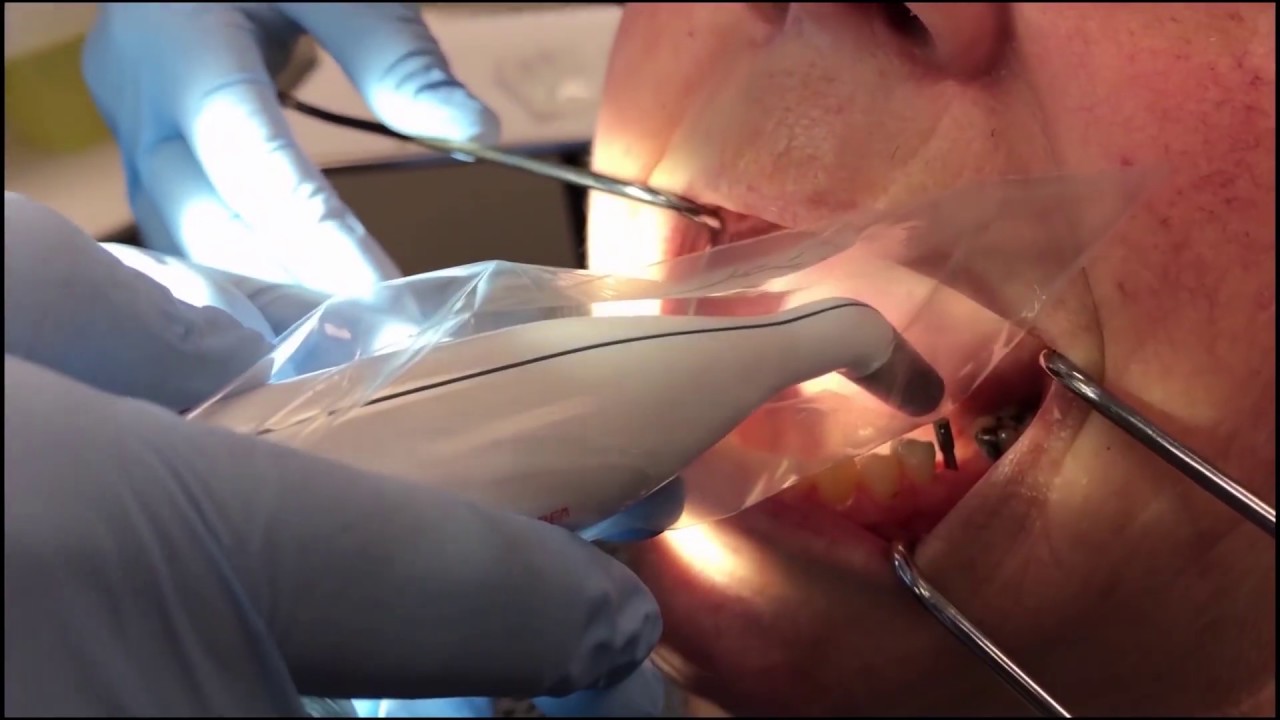 PENGUIN RFA IMPLANT STABILITY READING! | Citagenix