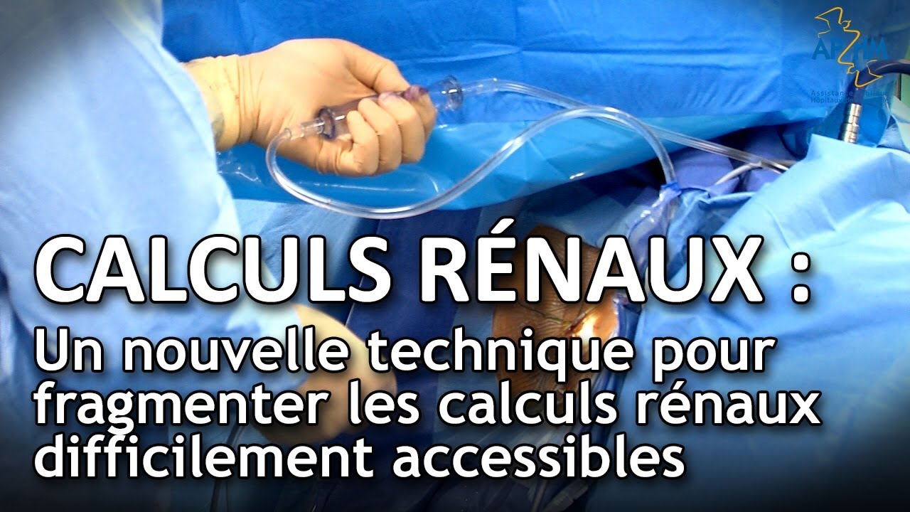 Calculs rénaux : un nouveau traitement pour les calculs difficiles à atteindre