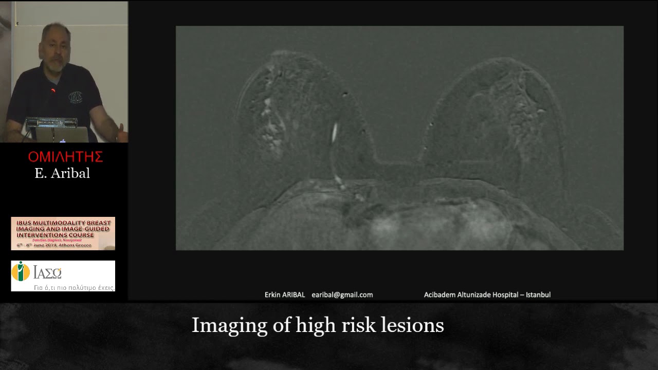 BREAST HIGH RISK LESIONS