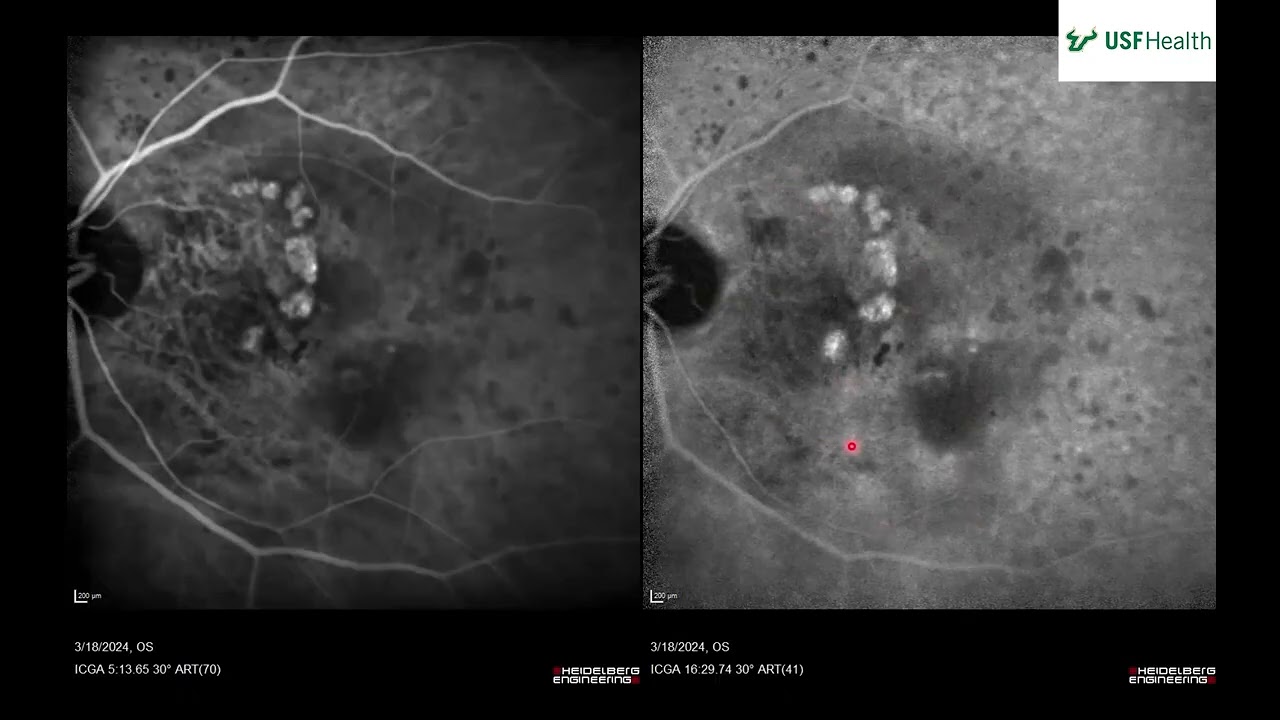 Polypoidal Choroidal Vasculopathy -  Grant Slagle 2025 03 14
