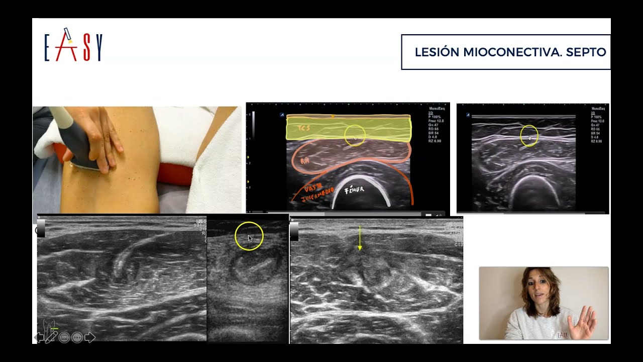 lesion septo recto anterior