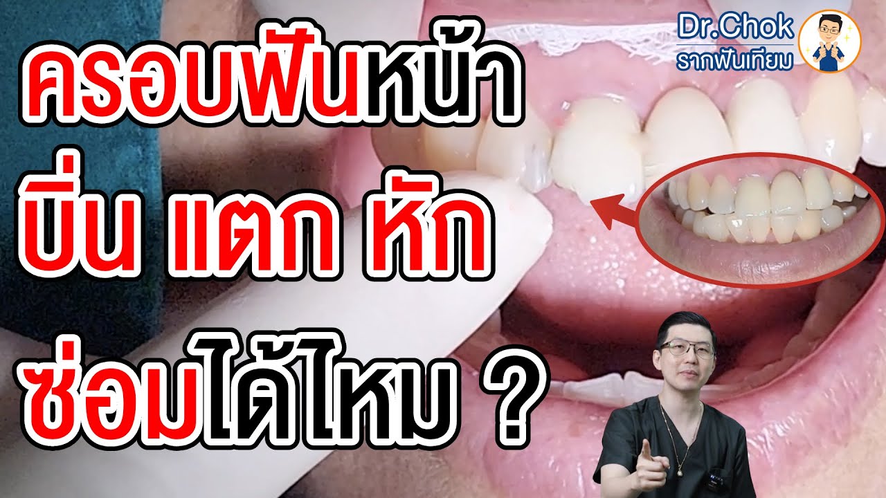 ครอบฟันหน้าบิ่น ซ่อมแบบไหนดี คลิปนี้มีคำตอบ ? | คลายปัญหารากฟันเทียมกับหมอโชค
