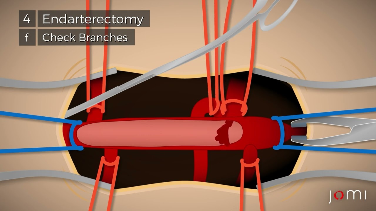 Femoral Endarterectomy for Severe Peripheral Arterial Disease