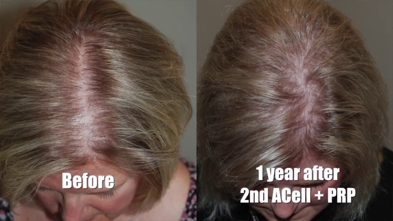 Non Surgical Alternatives for Hair Restoration - Northwest Hair Restoration