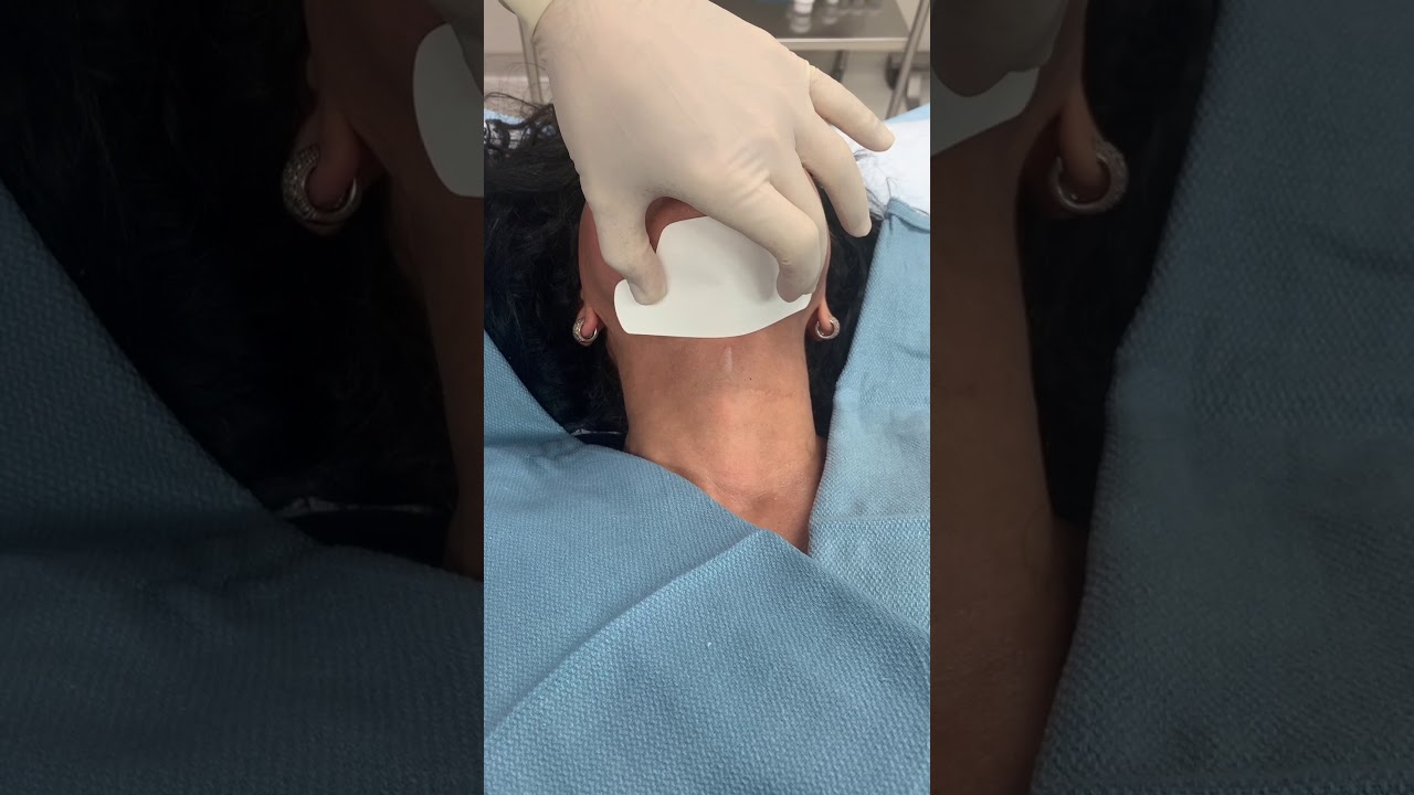 How to apply the Kybella Skin Marking Grid.