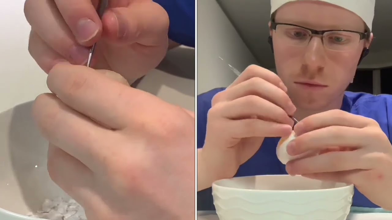 3 min video - Microsurgery Skills: Egg Shell Removal
