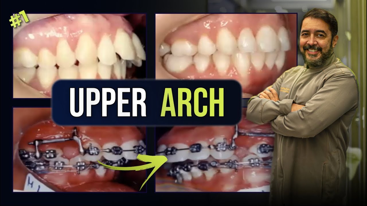 Closing Space in upper arch - Translation #1 | ORTHODONTIC TIPS
