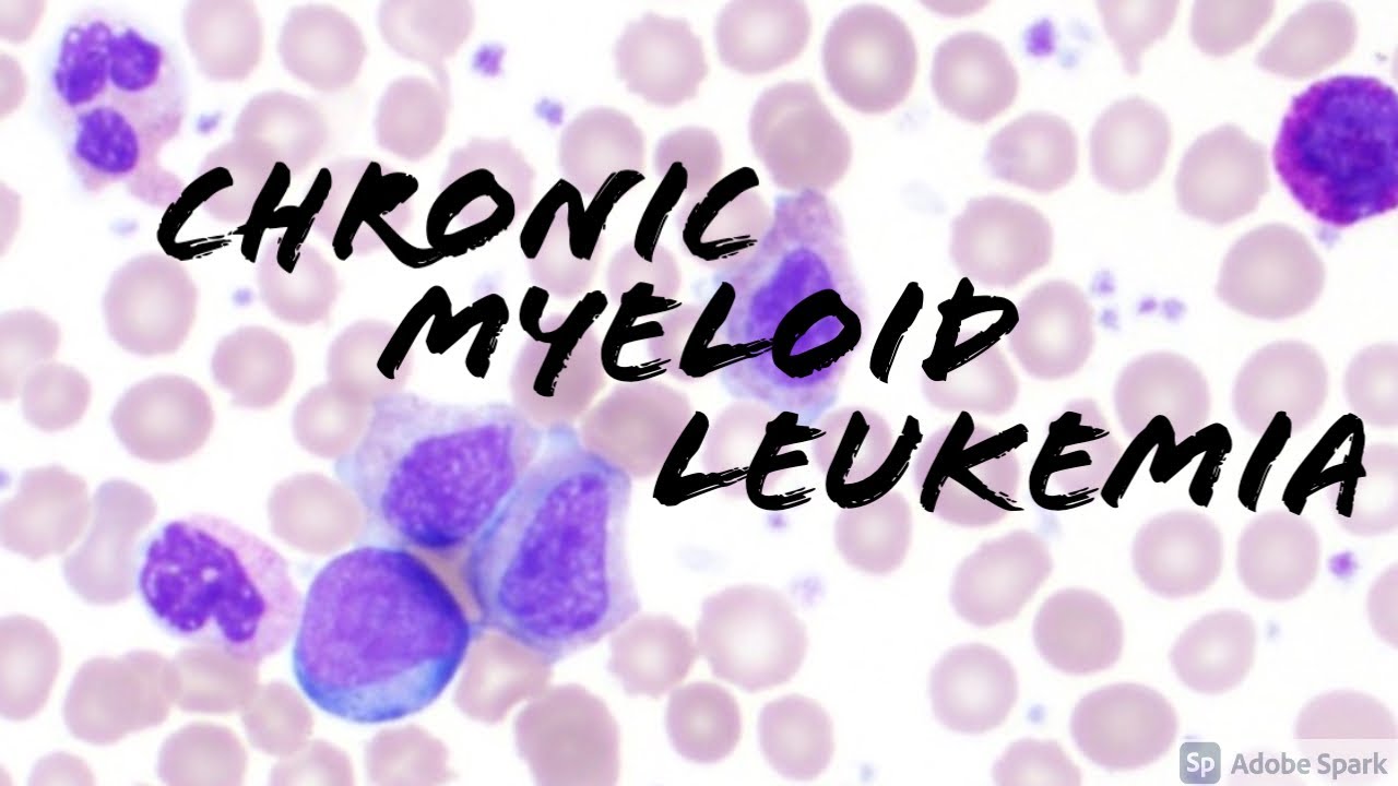 Chronic Myeloid Leukemia (CML) Peripheral Blood Smear (Hematopathology & Hematology)