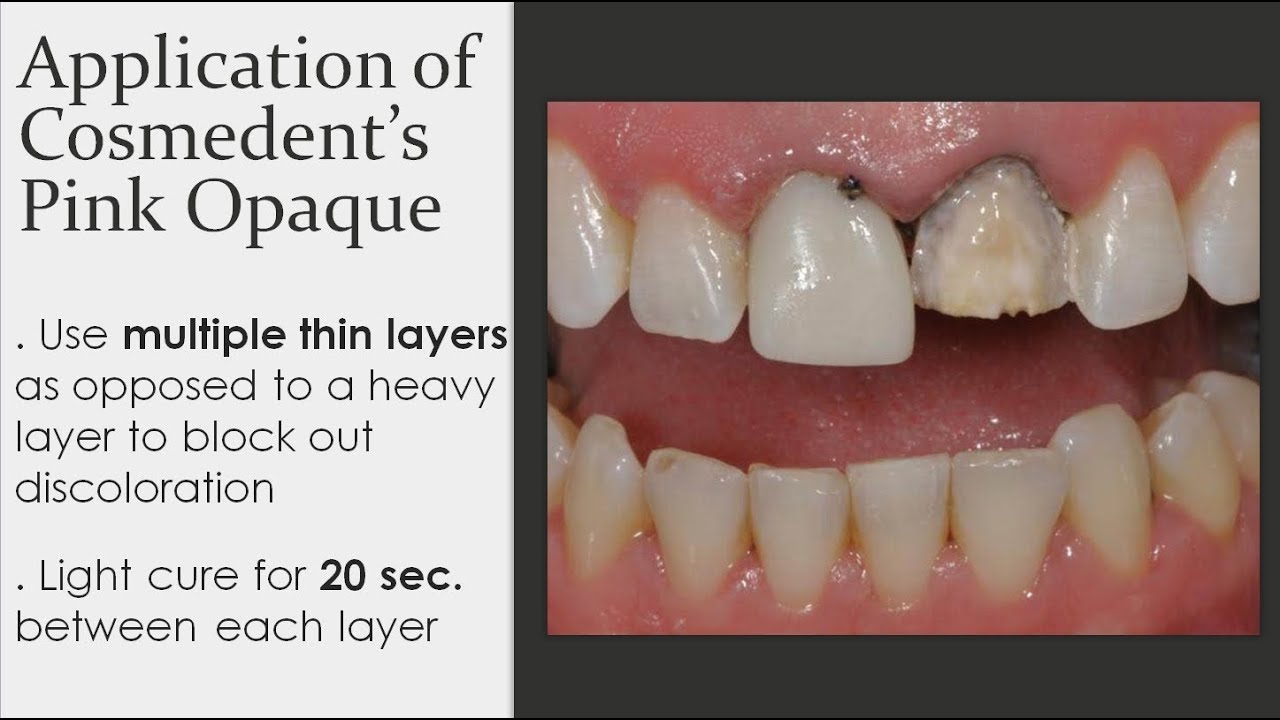Composite Veneer - Masking Discolored Teeth