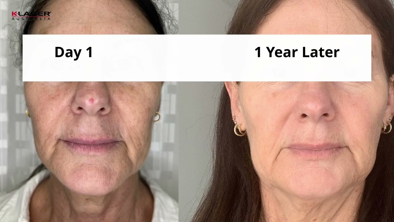 K-Laser Blue Derma Multiple Brown Spots And Skin Texture