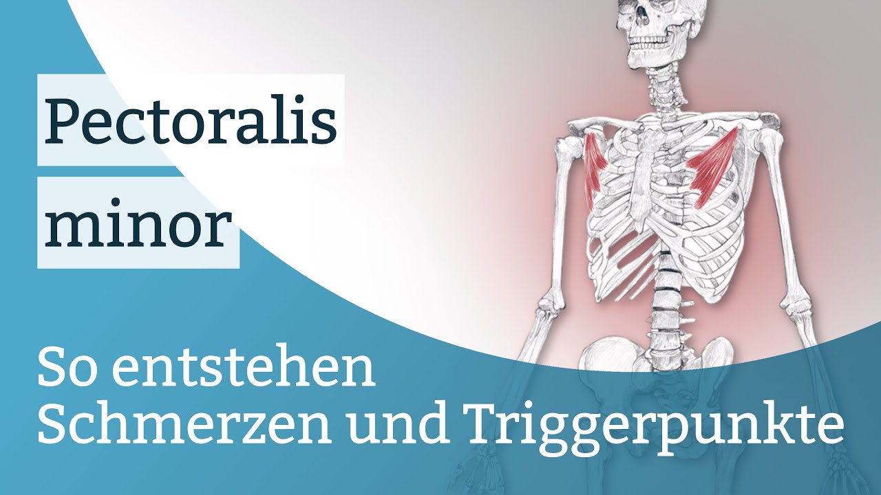 Pectoralis minor Schmerzen, Triggerpunkte und deren Aktivierung