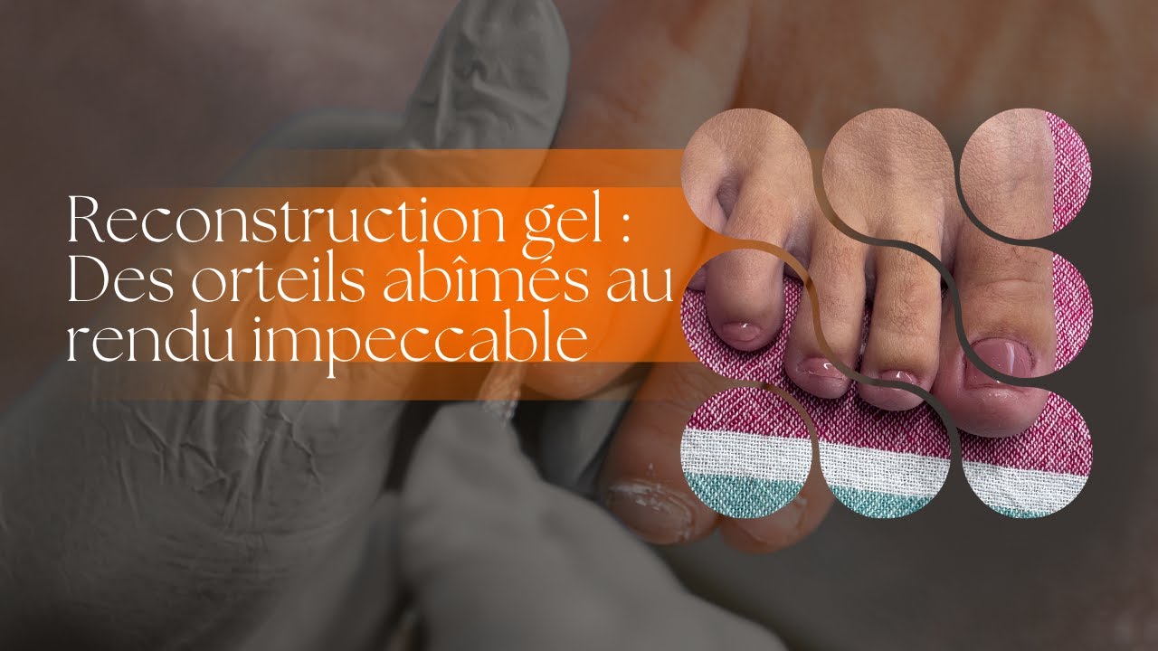 Reconstruction gel : des orteils abîmés au rendu impeccable en toute securité
