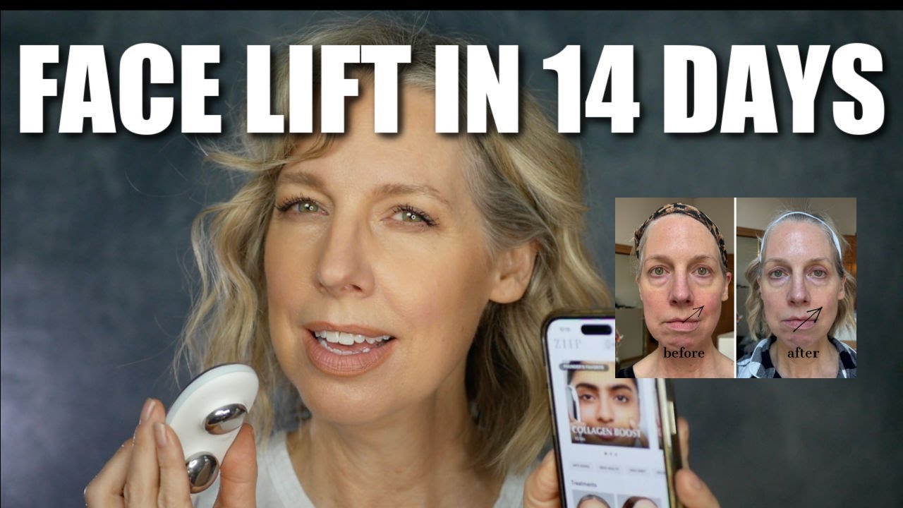 I Got a Face Lift in 14 days!  ZIIP 2.0 Review- Before and Afters