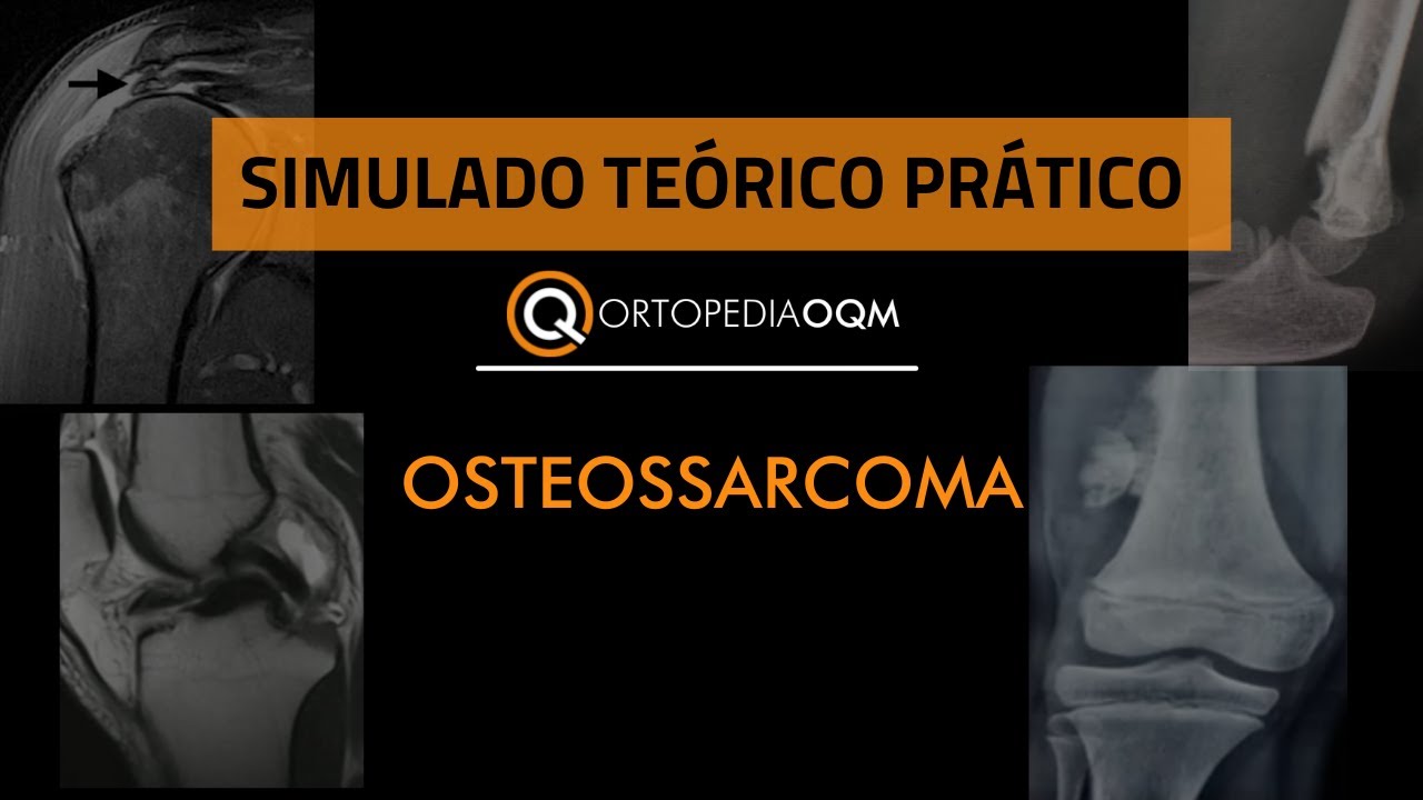 Osteossarcoma! Simulado Teórico-Prático OQM #DeOlhoNOTEOT SBOT Ortopedia OQM
