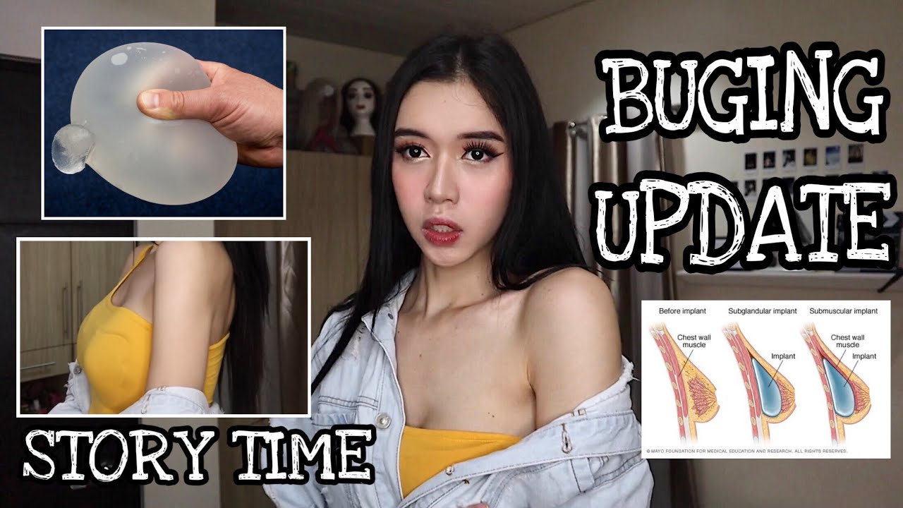 BUGING UPDATE ISANG TAON NA SYA!  + USAP TAYO ABOUT BREAST AUGMENTATION || JanaRickaFerde
