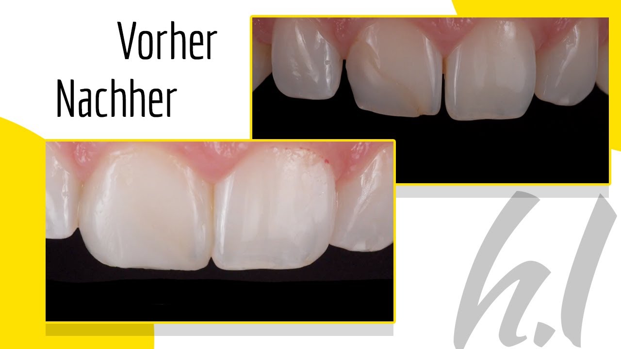 Komposit Veneering - Lückenschluss und komplexer Wiederaufbau - Dr. Hanni Lohmar