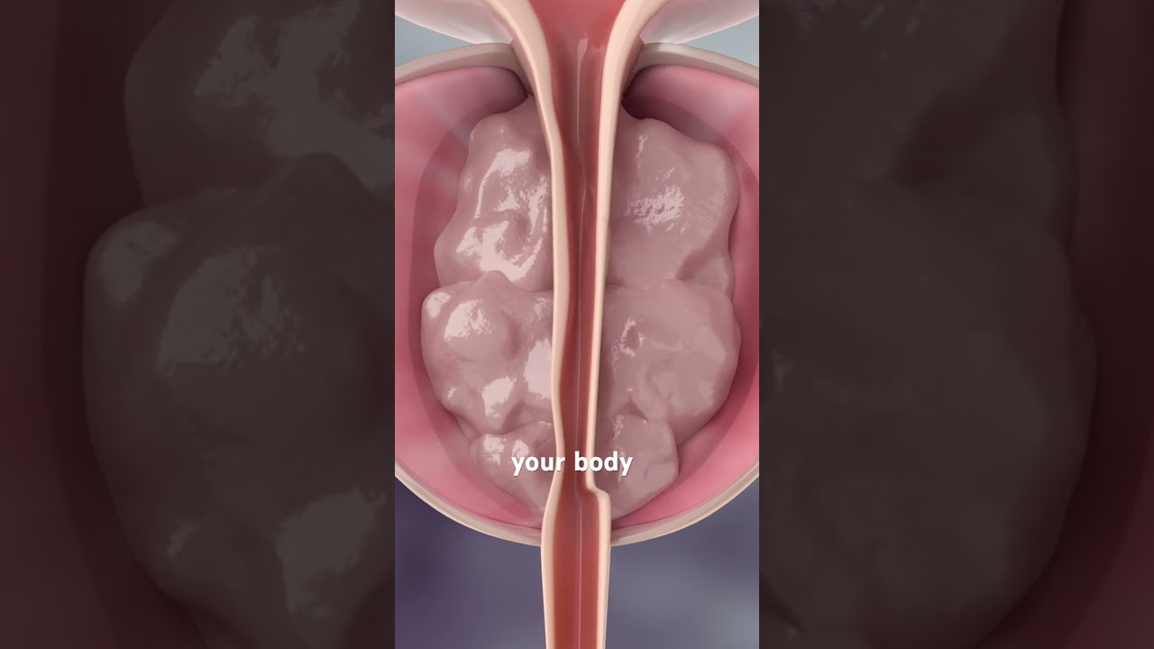 Лечение увеличенной простаты (Rezum и UroLift) 3D-анимация #мочеточник #эндоурология #урологический