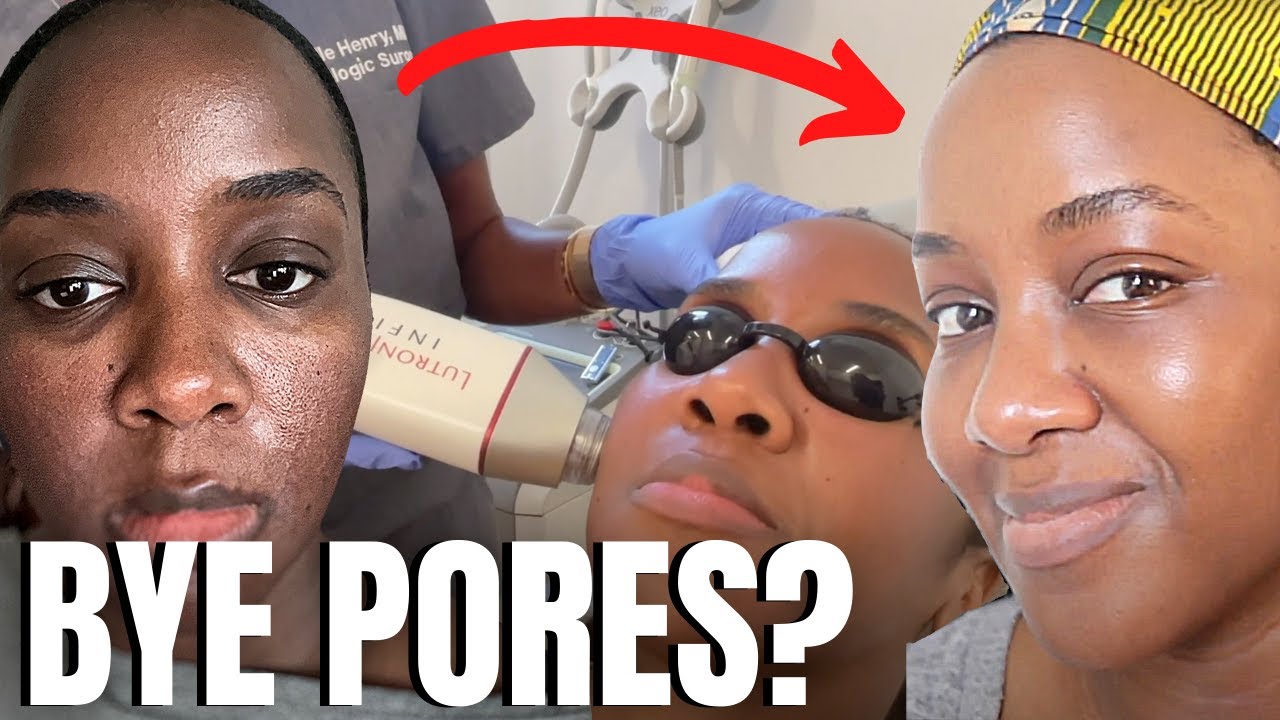 Getting Treatment for Large Pores (Dark Skin) | Black Skincare Over 40