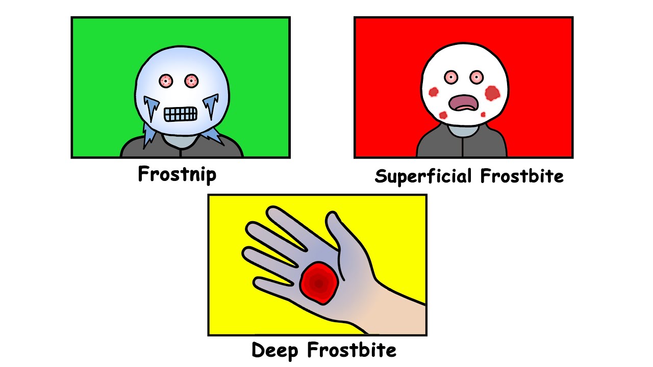 Every Stage of Frostbite Explained