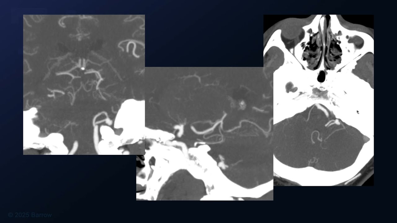 Far Lateral Approach for Clipping of a Ruptured p2 Posterior Inferior Cerebellar Artery Aneurysm