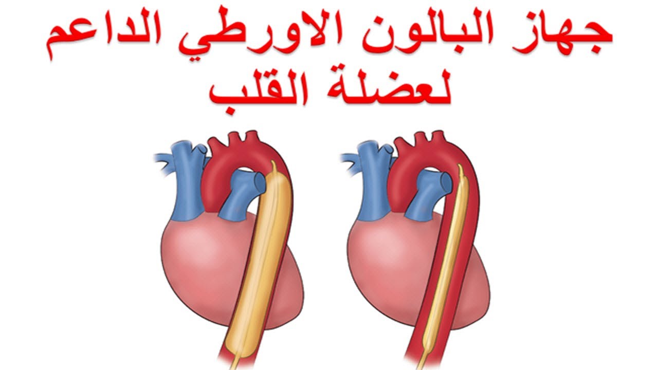 دور جهاز البالون الاورطي الداعم لعضلة القلب بعد جراحة الشرايين التاجية دعامة القلب و الازمة القلبية