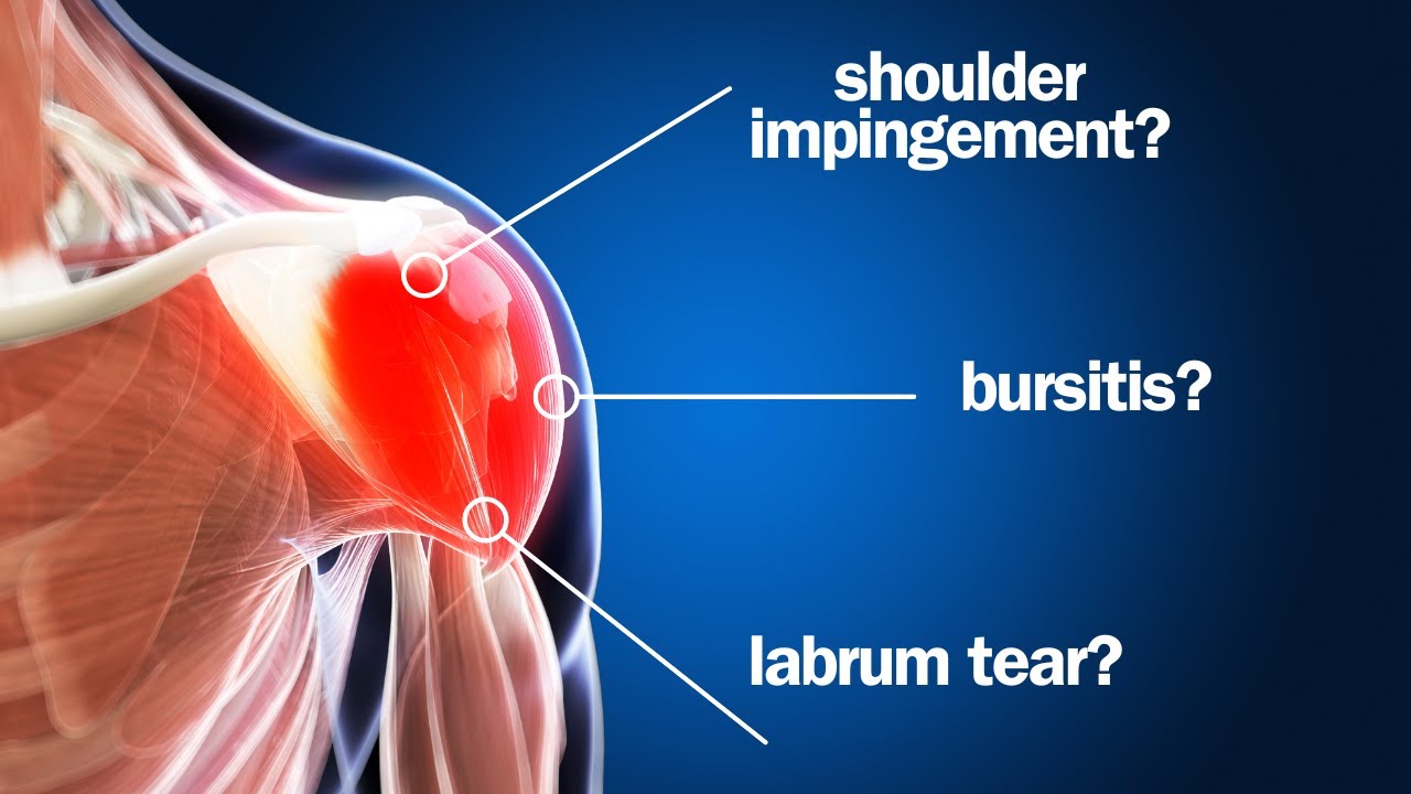 5 Shoulder Injuries That Might Be Mistaken For A Rotator Cuff Tear