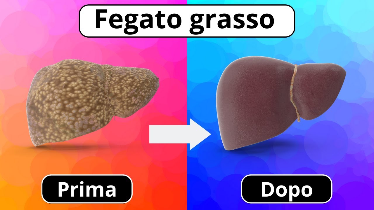 FEGATO grasso: i SINTOMI per riconoscerlo, la DIETA per guarire