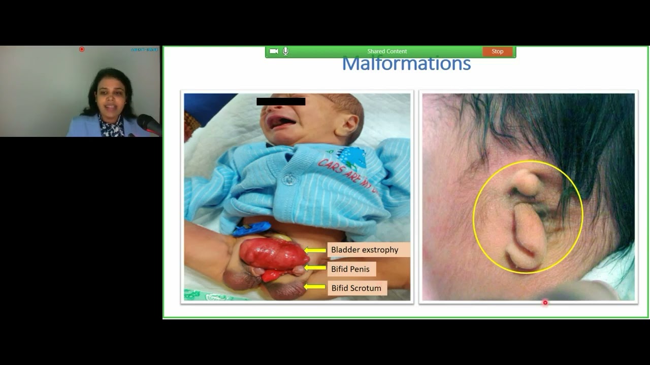 Congenital Birth Defects