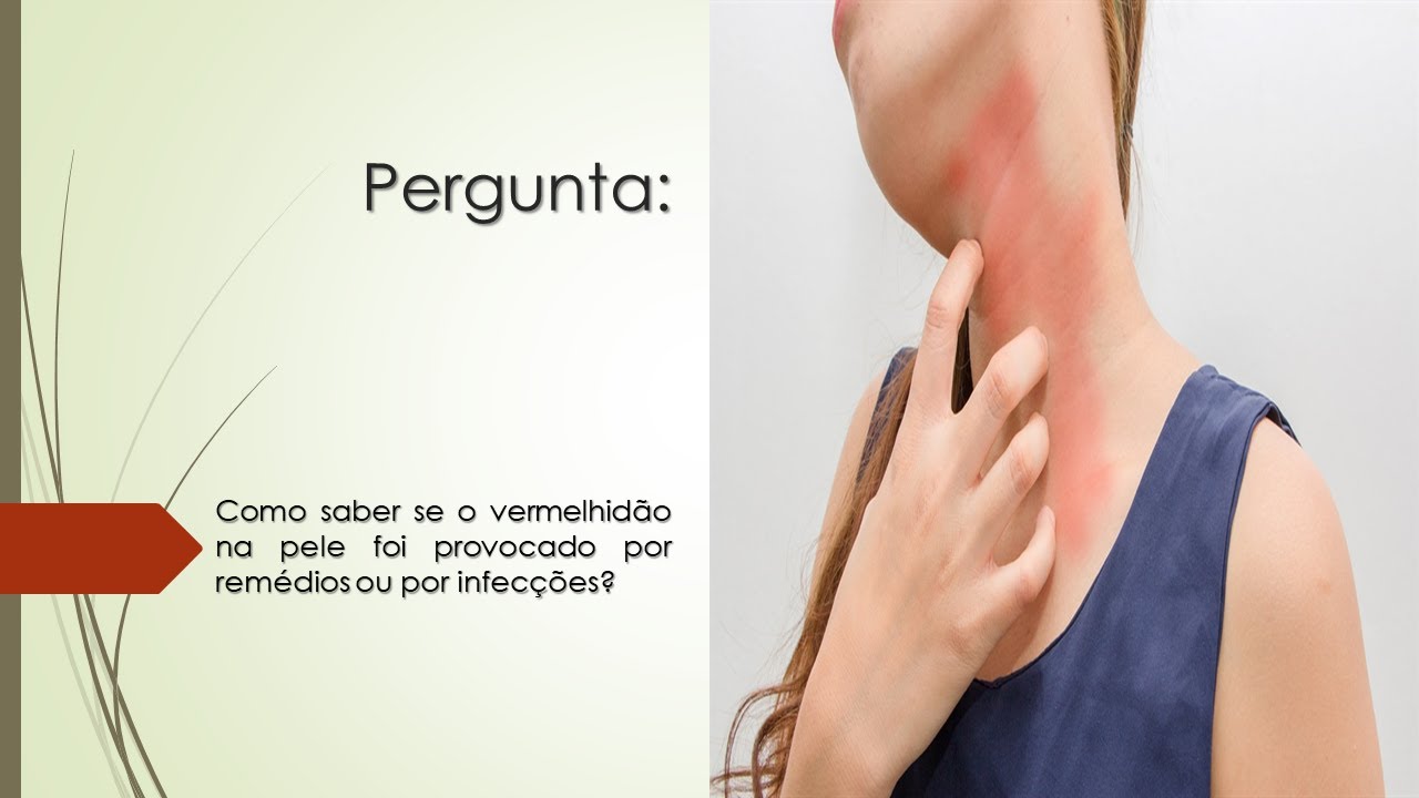 Como saber se a vermelhid&atilde;o na pele foi provocada por rem&eacute;dios ou por infec&ccedil;&otilde;es?