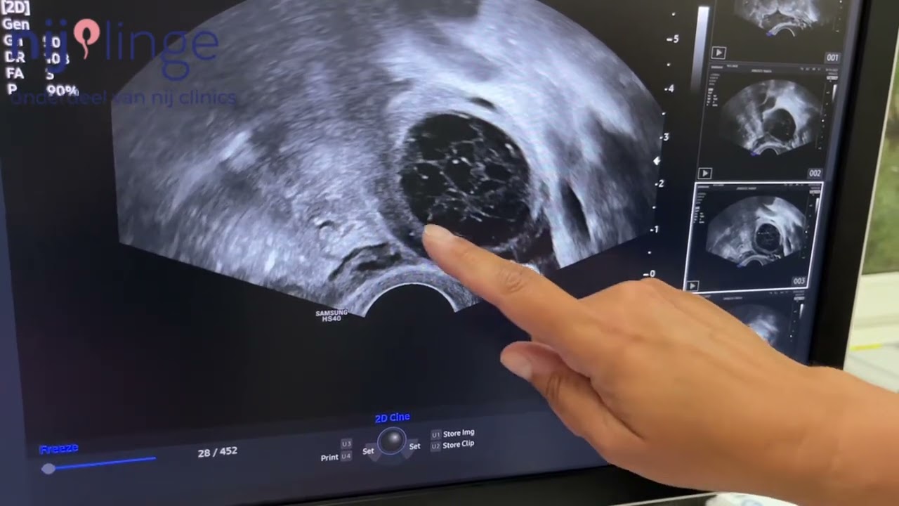Een corpus luteum (geel lichaampje) een paar dagen na de eisprong