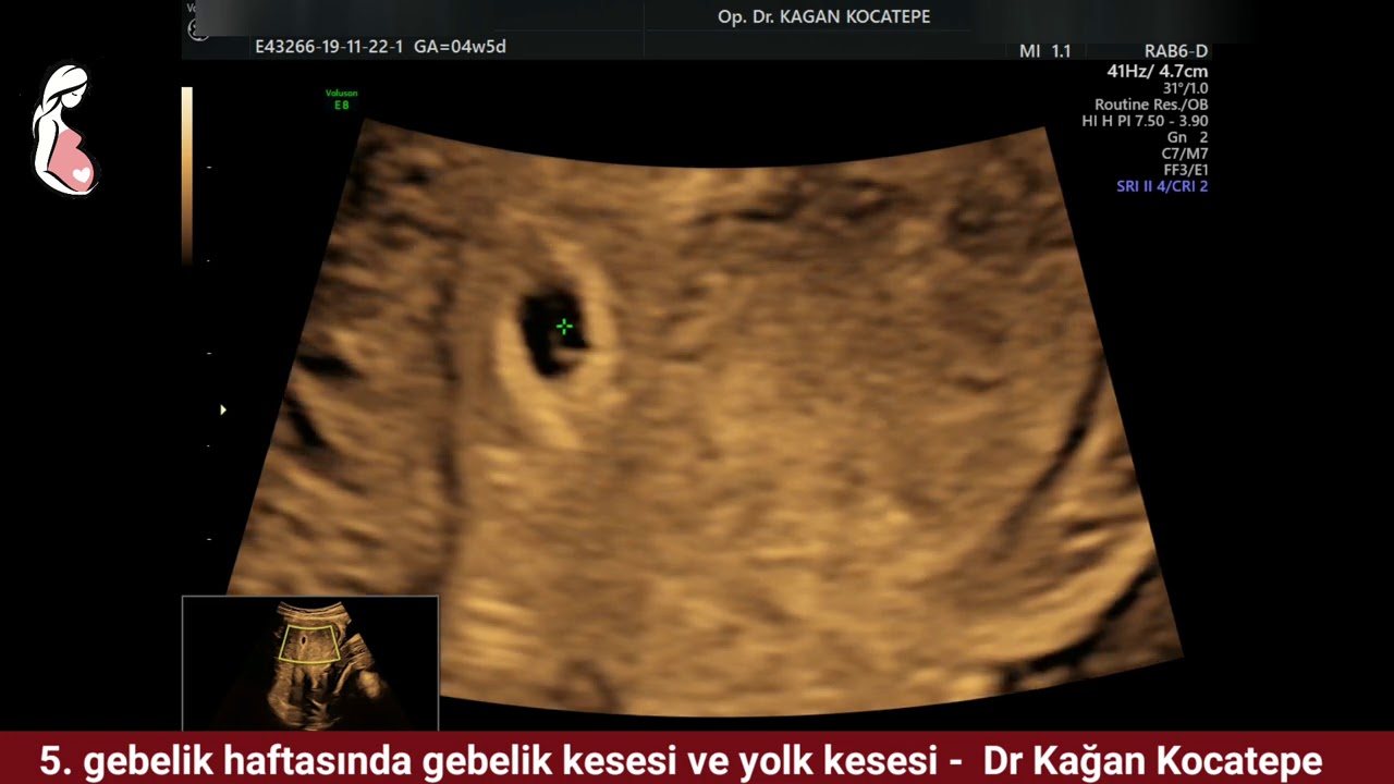 5. gebelik haftasında gebelik kesesi, desidua tabakası, yolk kesesi nasıl ve ne zaman g&ouml;r&uuml;n&uuml;r?