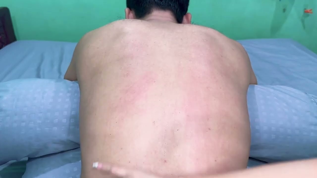 ASMR 🔥 RAPID Back Scratching MAX Tingles & Deep Sleep (No Talking) Relaxing Sleeping77