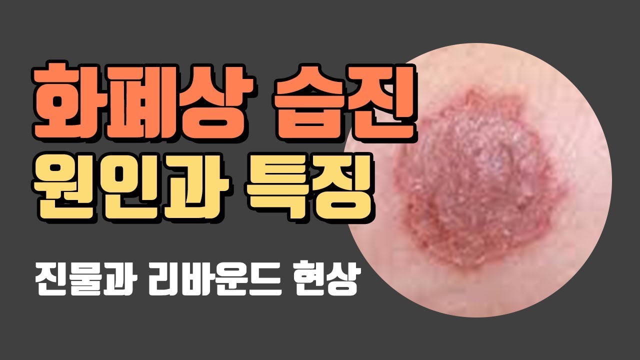 화폐상습진 의 모든 것 EP.01 원인과 특징에 대하여 [신덕일 한의사의 피부보감TV]