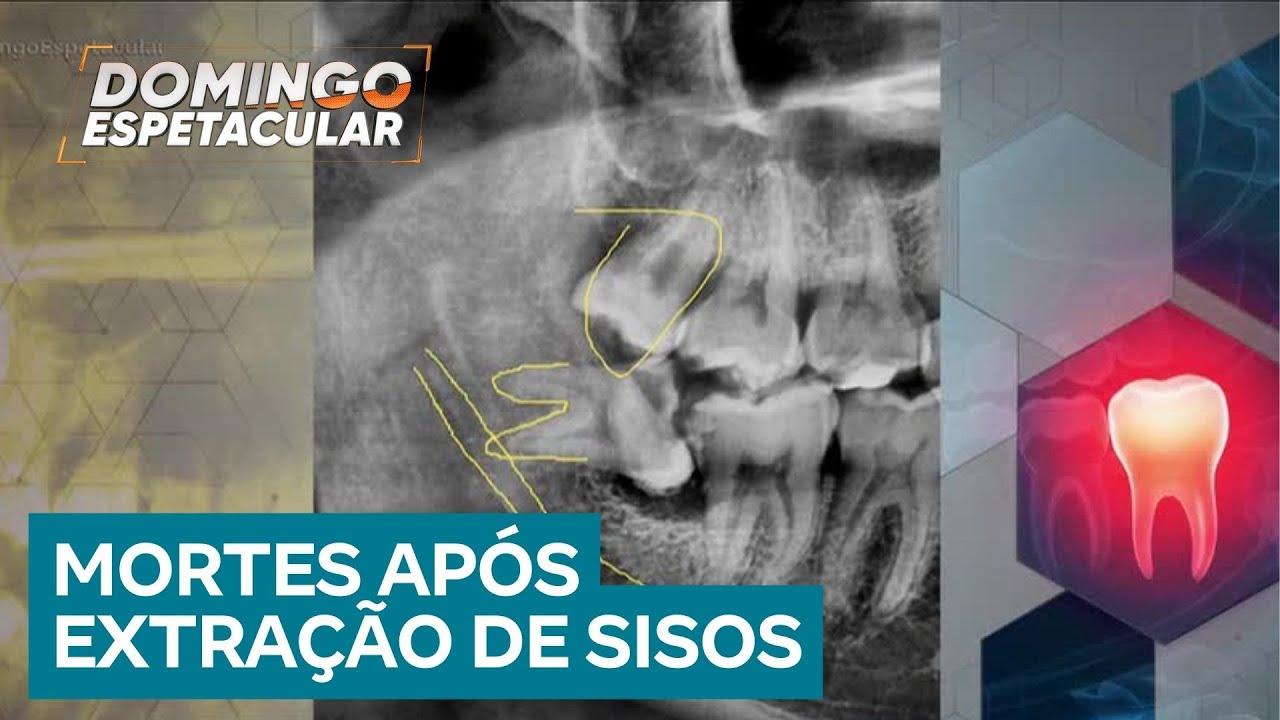 Casos de morte após extração de sisos geram investigação e mobilização