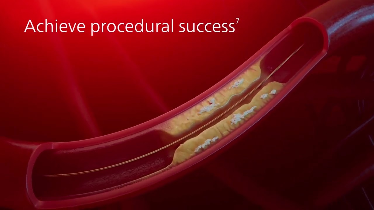 Philips ELCA Coronary Laser Atherectomy Catheter MOA