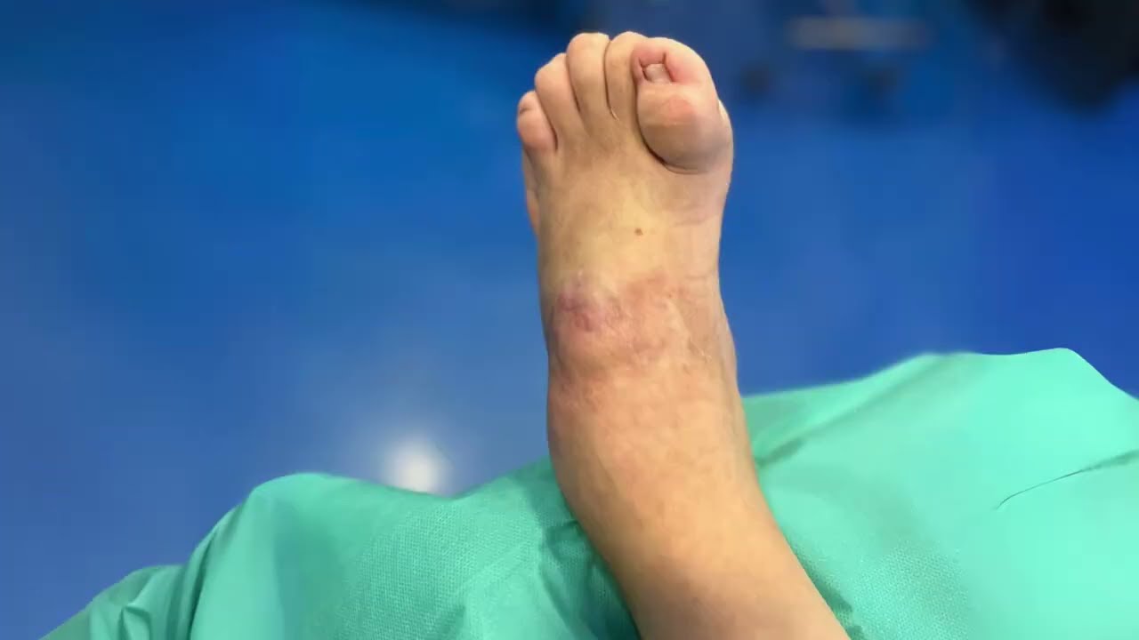 CIRUGÍA Y SUS RESULTADOS EN PACIENTES CON CHARCOT MARIE TOOTH