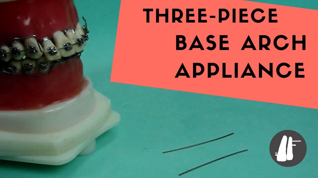 Three Piece Base Arch Appliance | Essential Biomechanics