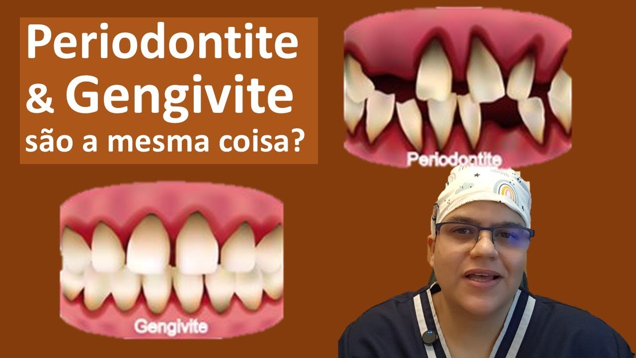 Gengivite É o Começo da Periodontite? Descubra Agora!| Master Pride Odontologia | Dra Bianca Rosa
