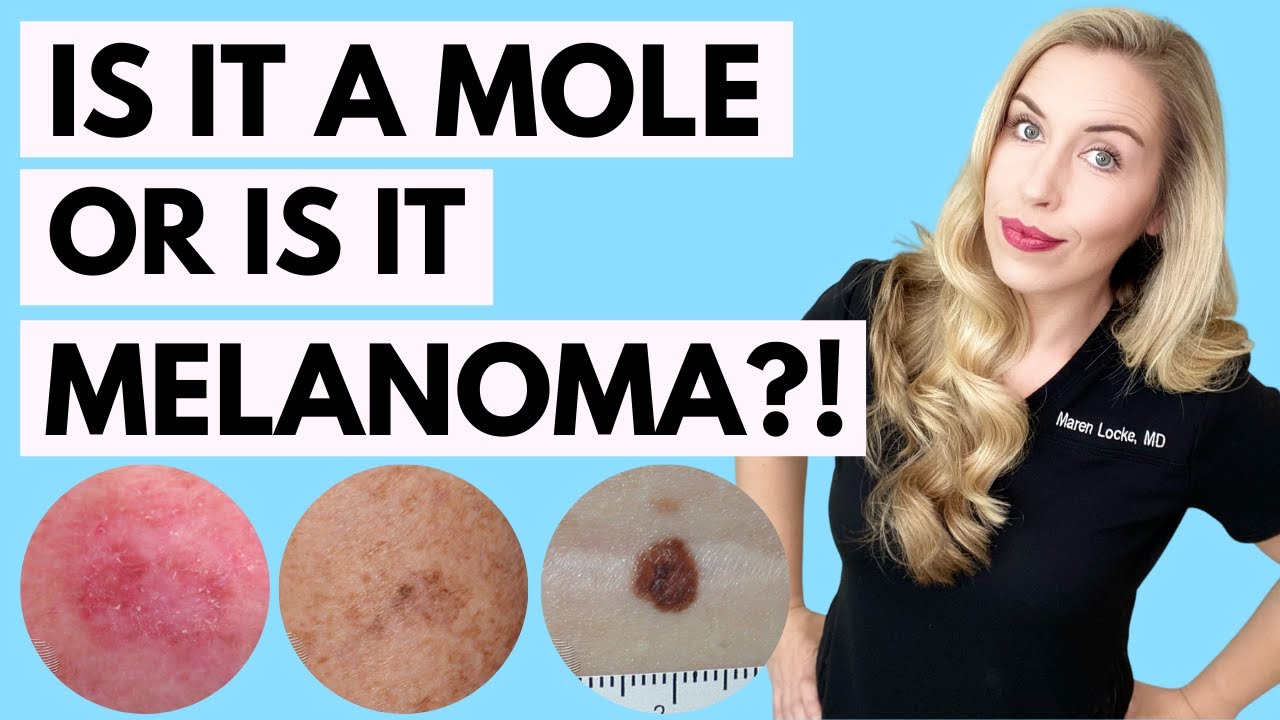 Is It A Mole or Melanoma? This Might Save Your Life! | Dermatologist Tips