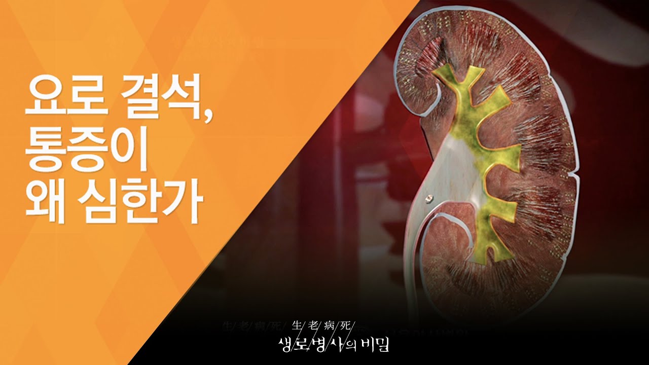 요로 결석, 통증이 왜 심한가 - (2015.9.30_555회 방송)_내 몸 속의 위험한 돌, 결석