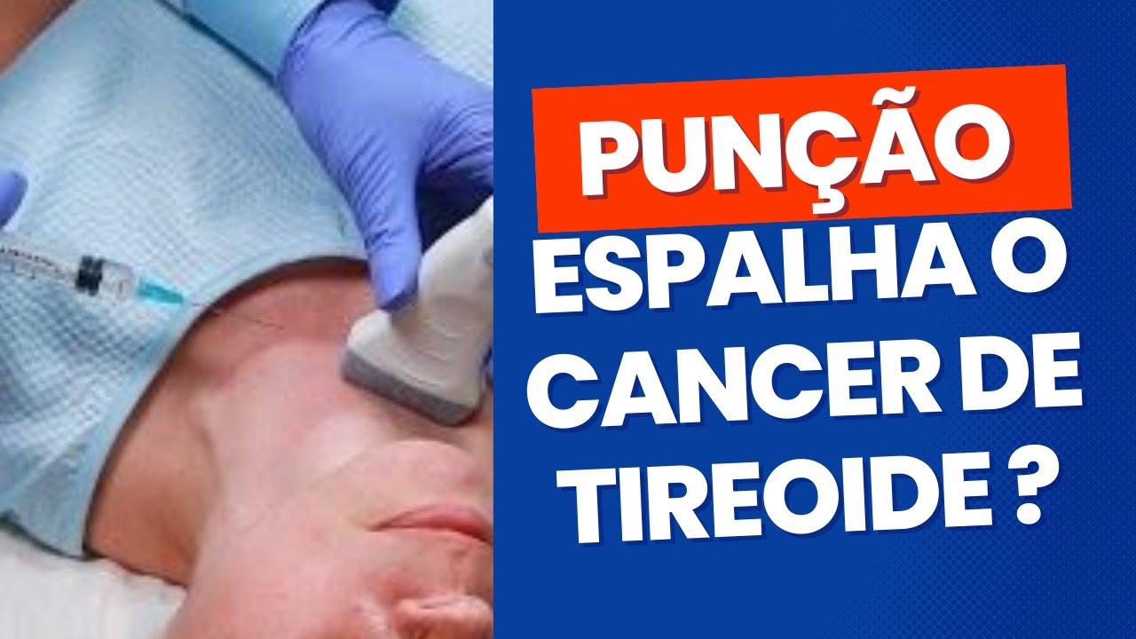 PAAF de n&oacute;dulo na tireoide pode espalhar o c&acirc;ncer?