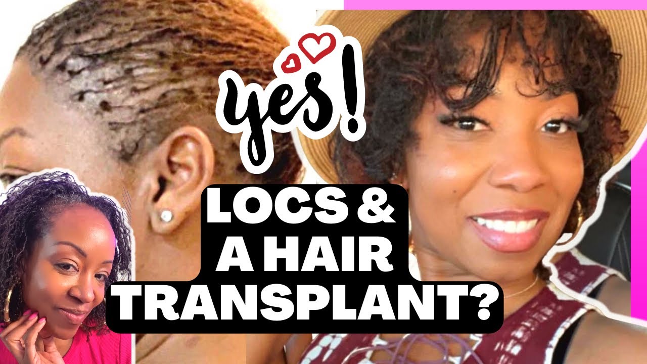 I Got Sisterlocks with a Hair Transplant | Scarring Alopecia | Hyperthyroidism | Brittany Danielle