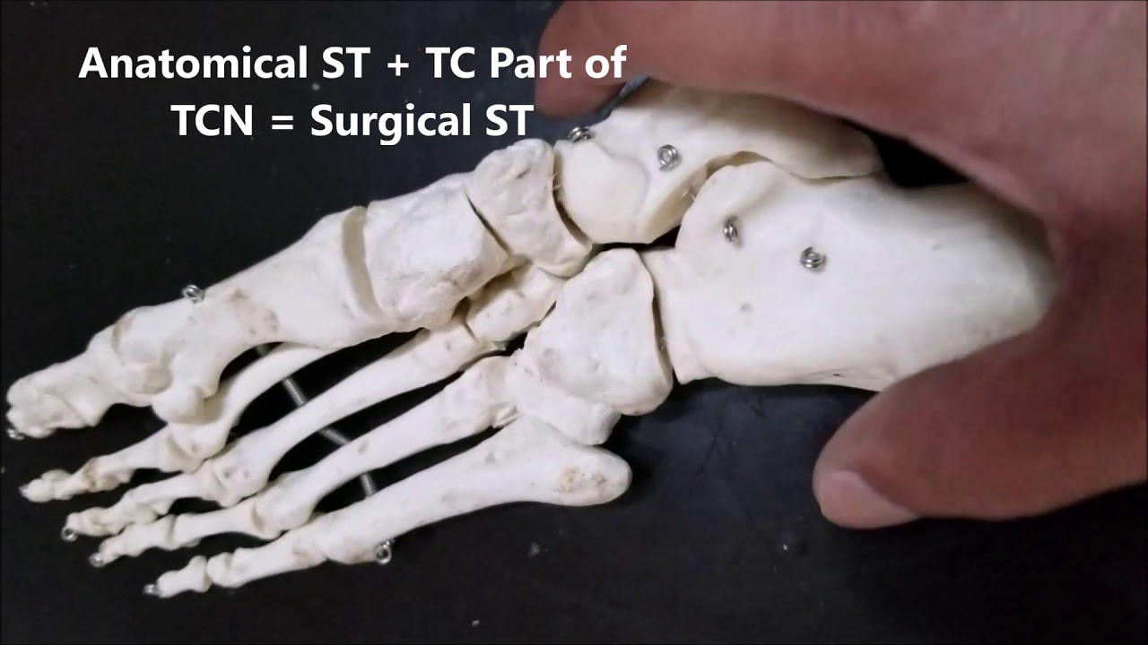 TARSALS Talus Calcaneus Navicular Cuboid Cuneiforms Joints Fractures Bohler Clinicals &ndash;Sanjoy Sanyal