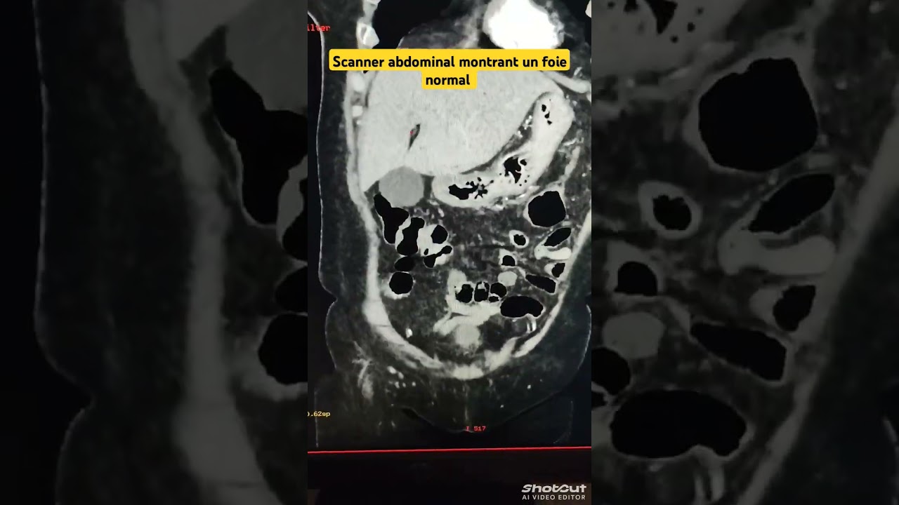 Scanner abdomino pelvien #radiologue #medecine #radiologie #manipradio