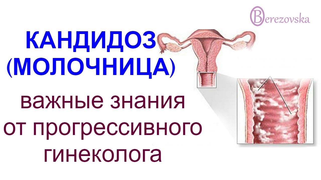 О кандидозе (молочнице) @Dr. Olena Berezovska