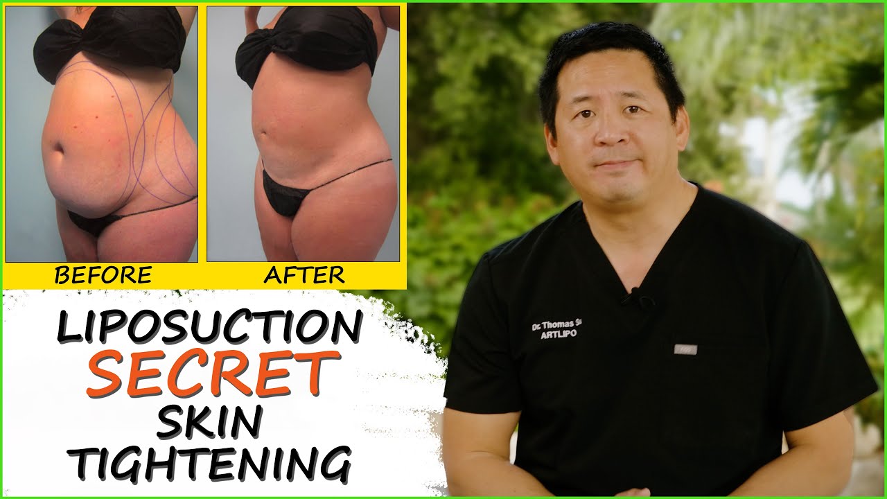 Skin Tightening Secret | The Best Liposuction Tampa, Florida | Lipedema Surgery | Expert Dr. Su